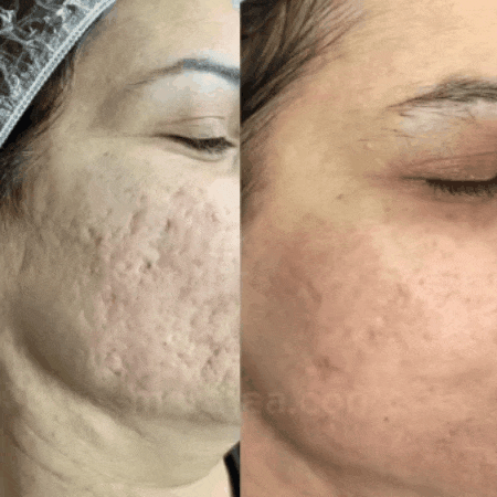 Derma-Pen Profesional (Para Estimular la producción de colágeno y rejuvenecer la piel)